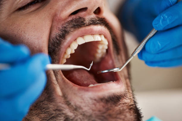 Best Emergency Tooth Extraction in Holdrege, NE
